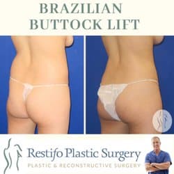 What Kind Of Scarring Is Expected After A Brazilian Butt Lift?